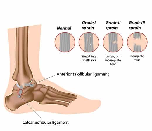 diagnosing grades of ankle sprains
