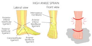 High Ankle Sprain & Syndesmosis Injury