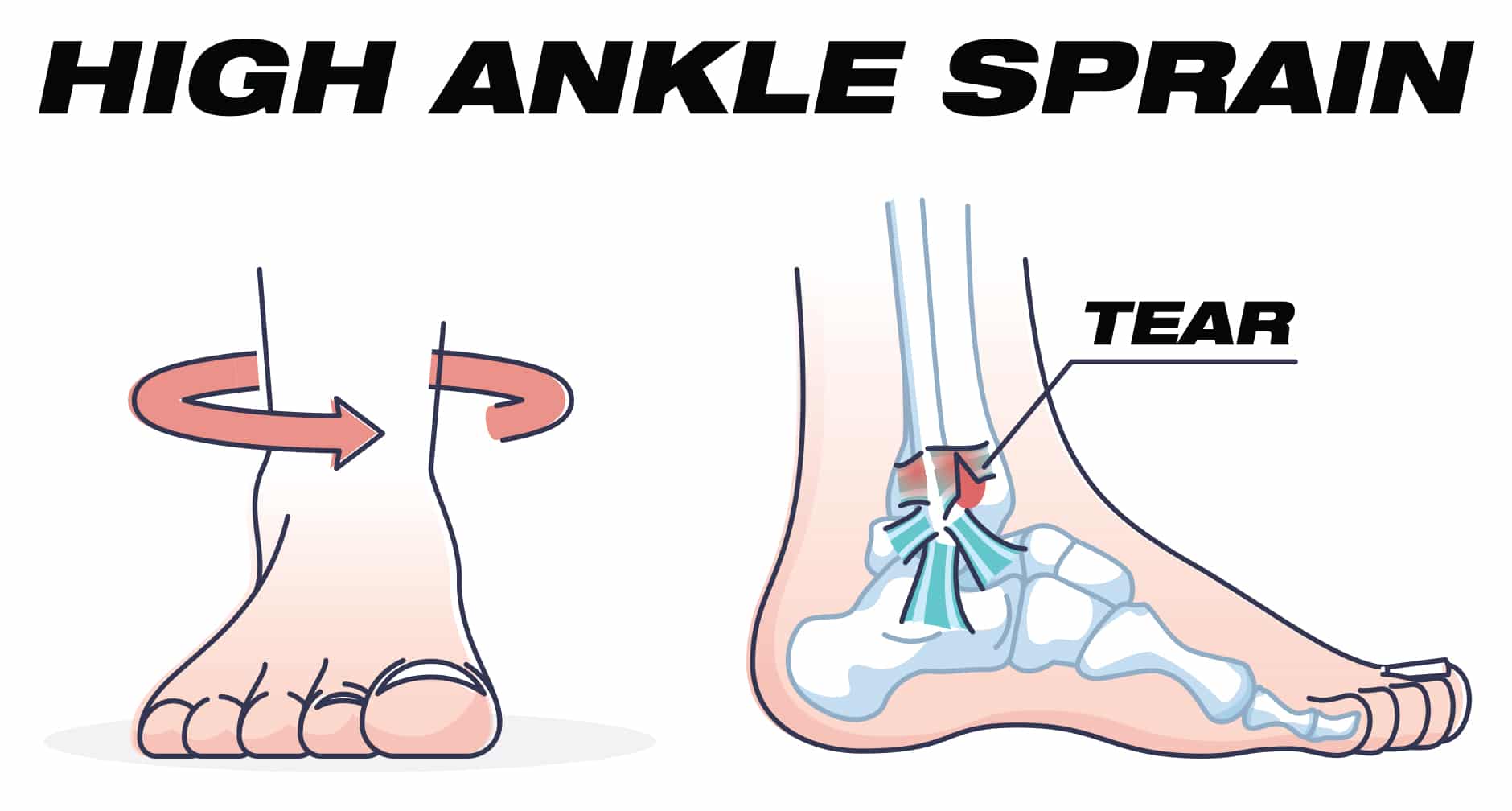 high ankle sprain diagram