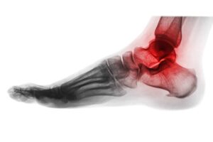 Arthritis of ankle . X-ray of foot . Lateral view . Invert color