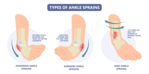 types-of-ankle-sprains