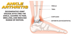 ankle arthritis-ultra ankle-ultra cts-ankle brace